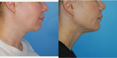 Mini Facelift before and after photo