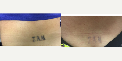 Tattoo Removal before and after photo