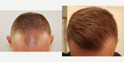 ARTAS Robotic Hair Transplant before and after photo