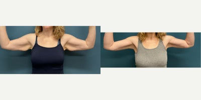 Body Lift before and after photo