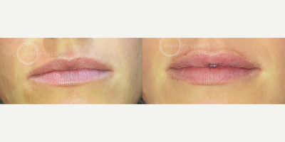 Dermal Fillers before and after photo