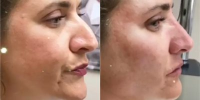 Dermal Fillers before and after photo