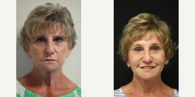 Facelift before and after photo
