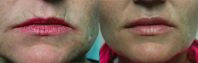 Restylane Silk before and after photo
