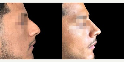 Rhinoplasty before and after photo