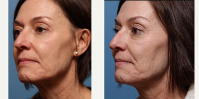 Sculptra before and after photo
