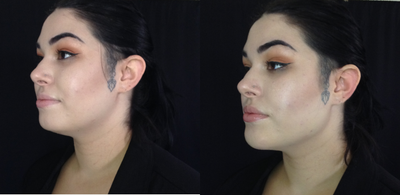 Dermal Fillers before and after photo