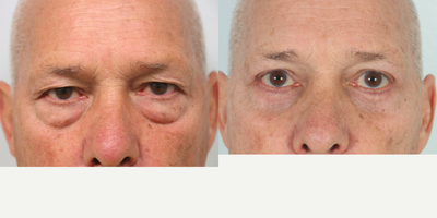 Eyelid Surgery before and after photo