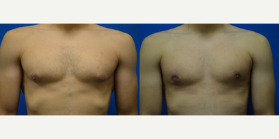 Gynecomastia Surgery before and after photo