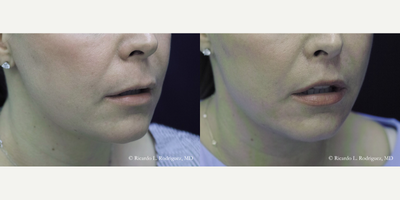 Lip Lift before and after photo