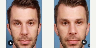 PRF Treatment before and after photo