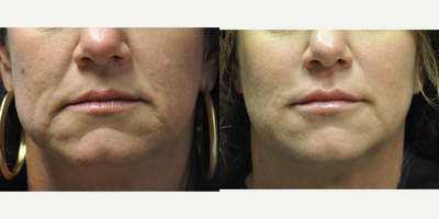 Restylane before and after photo