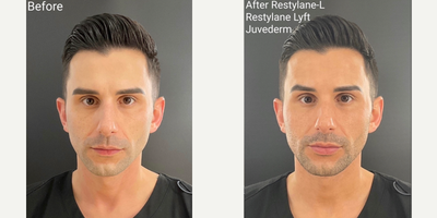 Restylane before and after photo