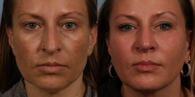 Cheek Augmentation before and after photo
