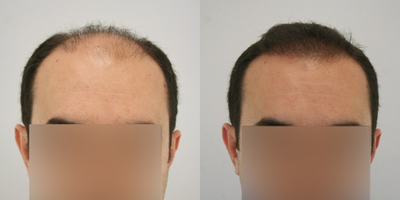 FUE Hair Transplant before and after photo