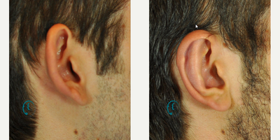 Ear Surgery before and after photo