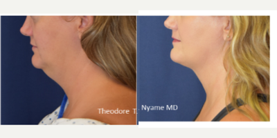 Liposuction before and after photo