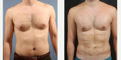 Pec Implants before and after photo