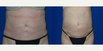 Vaser Liposuction before and after photo