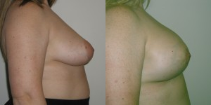 Breast Lift before and after photo