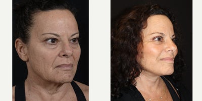 Eyelid Surgery before and after photo