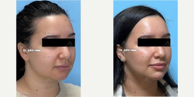 Botox before and after photo