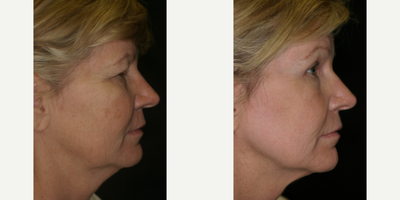 CO2 Laser before and after photo