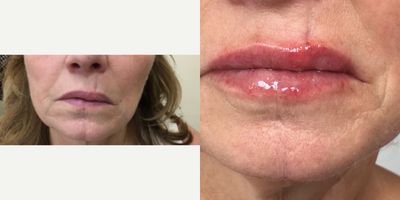 Dermal Fillers before and after photo