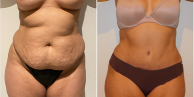 Diastasis Recti Repair before and after photo