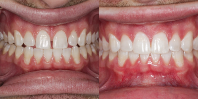 Invisalign before and after photo