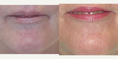 Laser Resurfacing before and after photo