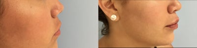 Restylane Silk before and after photo