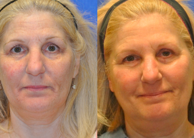CO2 Laser before and after photo