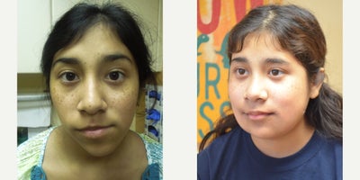 Facial Reconstructive Surgery before and after photo