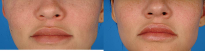 Lip Fillers before and after photo
