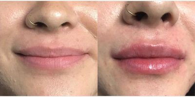 Restylane before and after photo