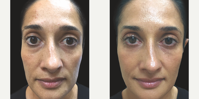 Sculptra before and after photo