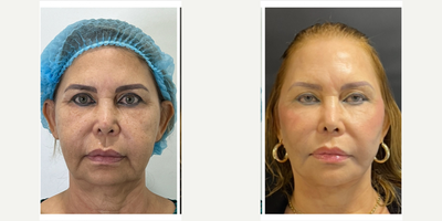 SMAS Facelift before and after photo