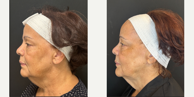 FaceTite before and after photo
