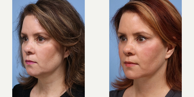 Facial Fat Transfer before and after photo