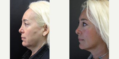 Facelift before and after photo