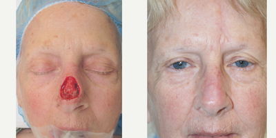 Facial Reconstructive Surgery before and after photo