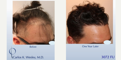 FUE Hair Transplant before and after photo