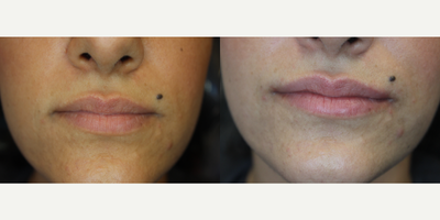 Lip Fillers before and after photo