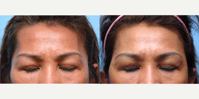 Radiesse before and after photo