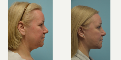 Rhinoplasty before and after photo
