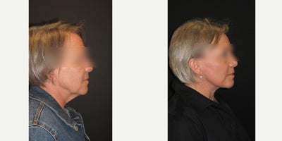 CO2 Laser before and after photo