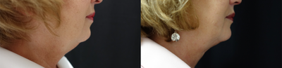 CoolSculpting before and after photo