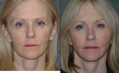 Facelift before and after photo
