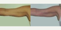 Liposuction before and after photo